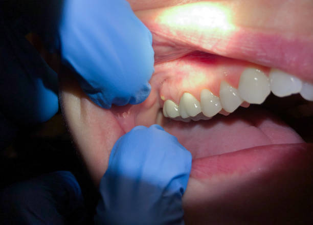 Best Emergency Tooth Extraction in Poquoson, VA